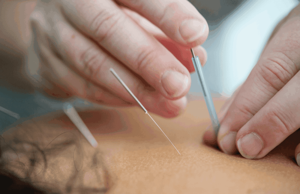 Acupuncture needles being carefully applied to a patient's back